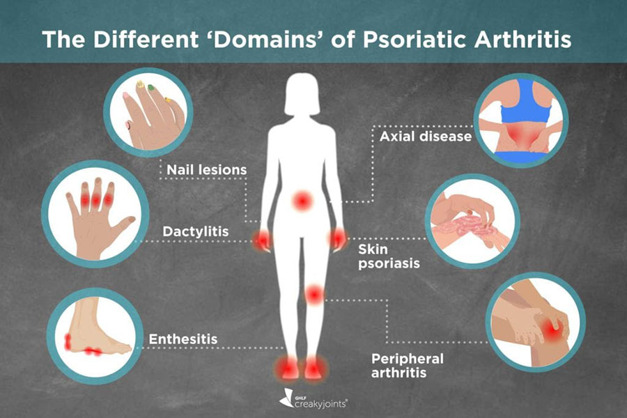 area that psoratic arthritis affect